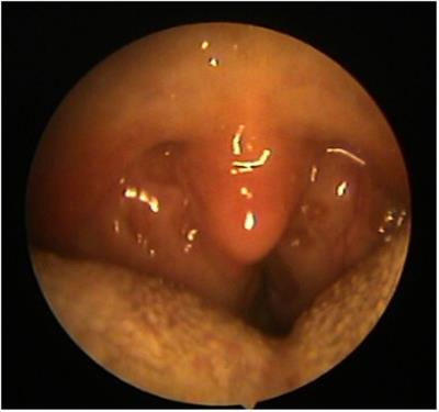 Effect of tonsillectomy in a child with obesity and obstructive sleep apnea: A case report and review of the literature